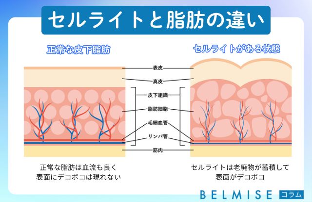 セルライトと脂肪の違い