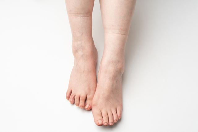 靴下の跡が残る主な原因