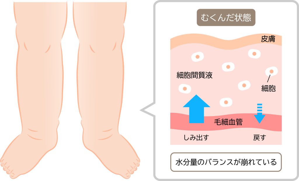 むくみの状態